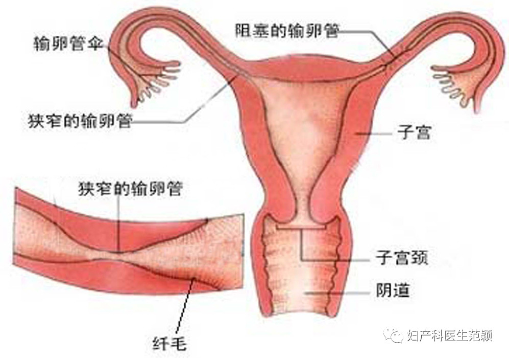 卵巢和阑尾的位置图片