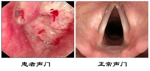 声门对比_副本.jpg